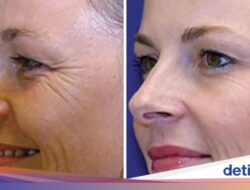 20 Tahun Pakai Botox Vs Tidak