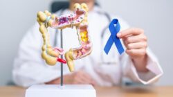 5 Hal yang Disorot Sepele Ini Ternyata Tingkatkan Risiko Kanker Usus Besar