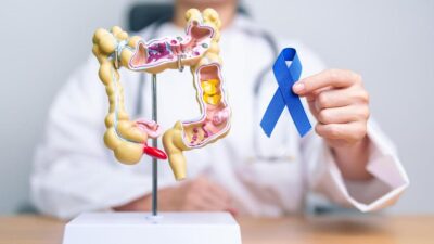 5 Hal yang Disorot Sepele Ini Ternyata Tingkatkan Risiko Kanker Usus Besar