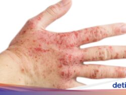 5 Mitos Seputar Eksim yang Masih Dipercaya, Benarkah Bisa Menular?